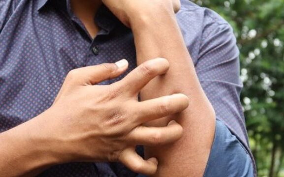 Keresztallergia tünetei és a leggyakoribb pollen-élelmiszer kapcsolatok